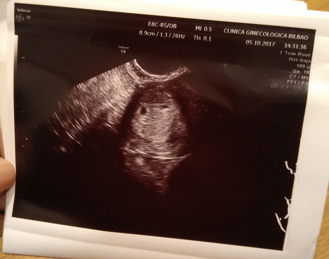 ecografía de 4 semanas de embarazo
