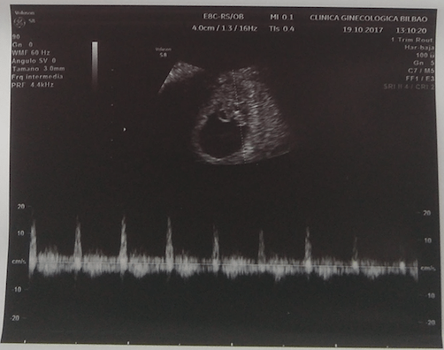 Ecografía de 6 semanas de embarazo
