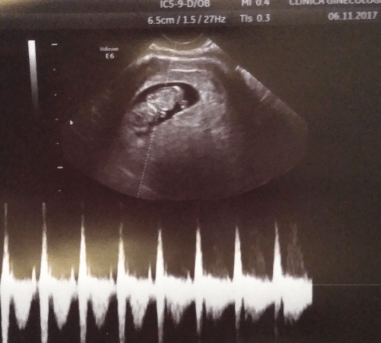 Ecografía de 9 semanas de embarazo