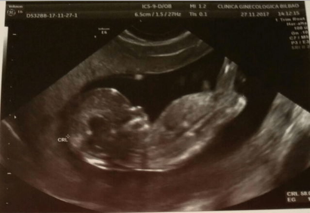Ecografía de 12 semanas de embarazo